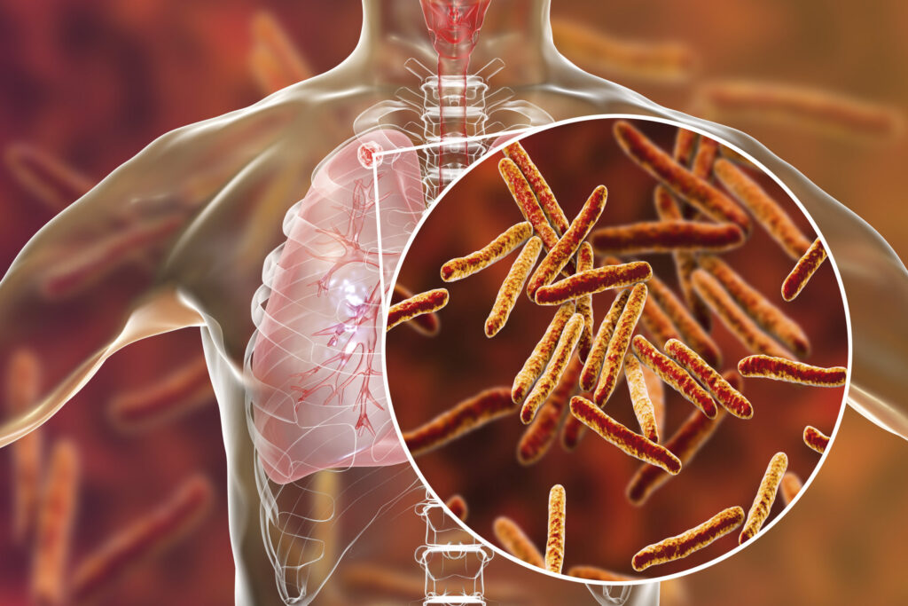 Tuberculosis (TB) and COVID-19 co-infection: Investigating the Interactions between Mycobacterium Tuberculosis and SARS-CoV-2