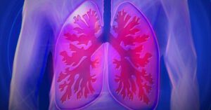 Assessing impact of Covid-19 on patients with Chronic Obstructive Pulmonary Disease